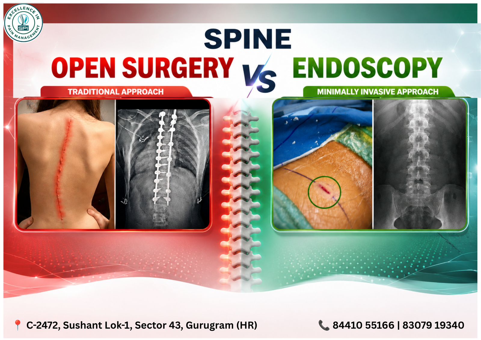 Open Surgery vs Endoscopic Spine Surgery